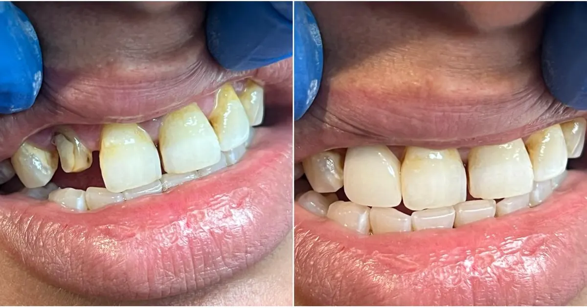 Tooth Cap or Dental Crown: What It Is, When You Need One, and What It Costs in Indirapuram