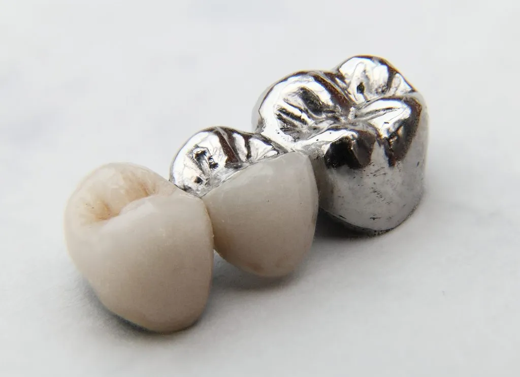 Best Metal Dental Bridge in Indirapuram treatment at Kosmoss Dental Indirapuram