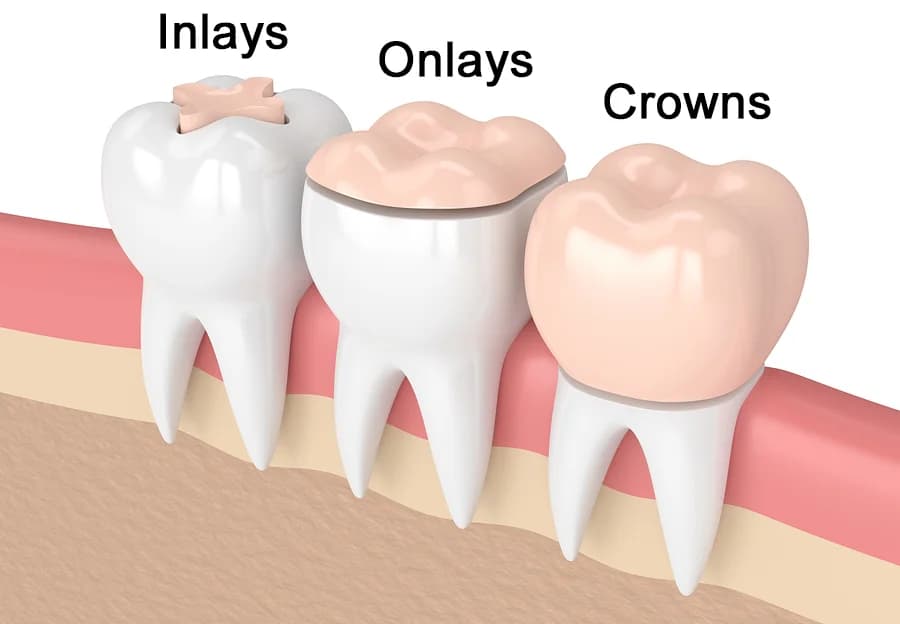 Inlays/Onlays treatment at Kosmoss Dental Indirapuram