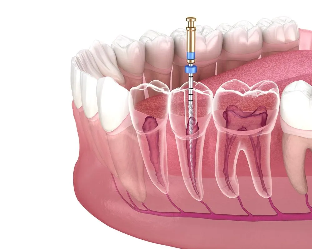 Re-Root Canal Treatment in Indirapuram treatment at Kosmoss Dental Indirapuram