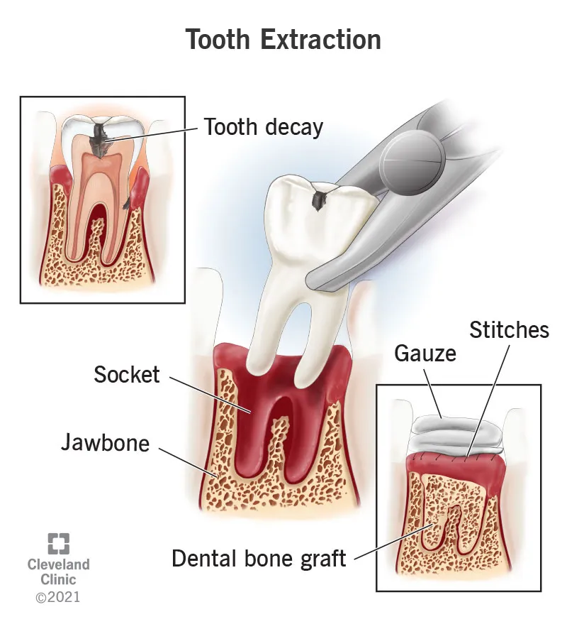 Regular Tooth Extraction in Indirapuram treatment at Kosmoss Dental Indirapuram