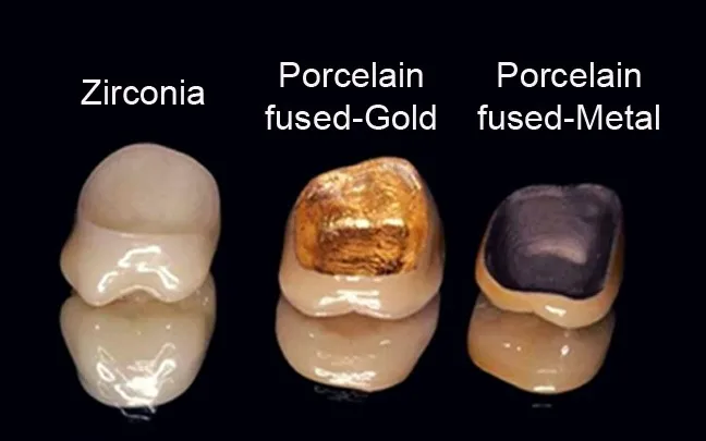 Best Zirconia Metal-Free Crowns in Indirapuram treatment at Kosmoss Dental Indirapuram