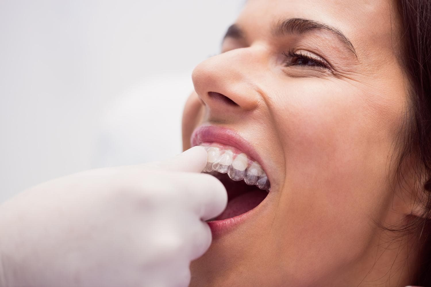 Invisible Braces in Indirapuram; Affordable and High Quality
