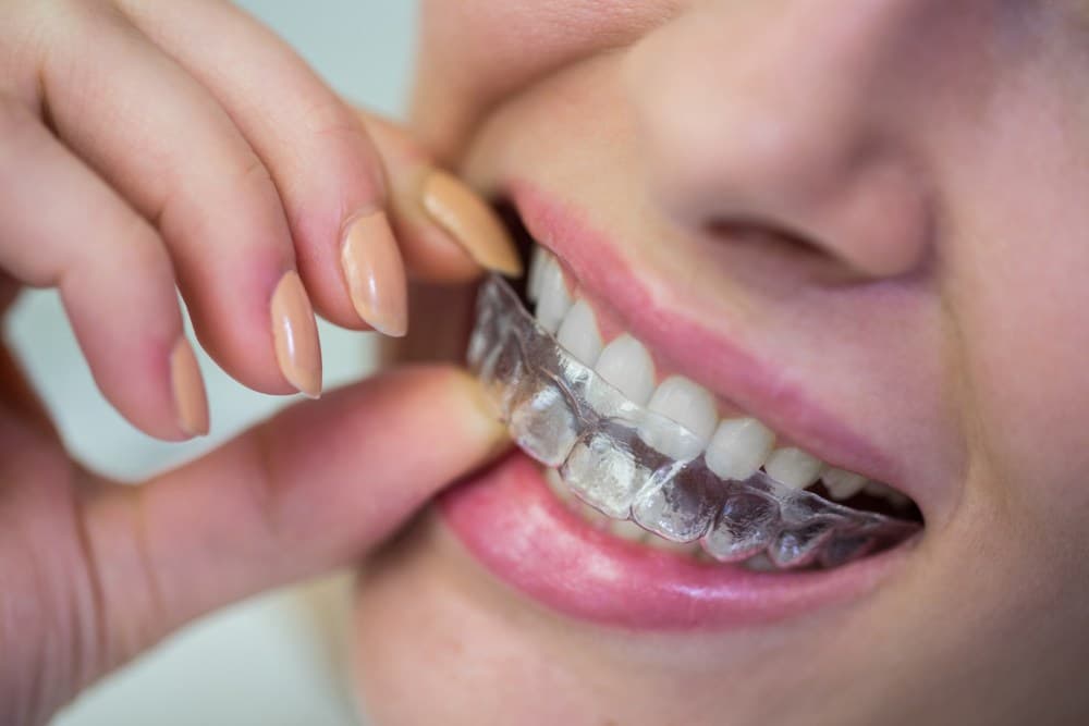 How Invisible Aligners Work at Kosmoss