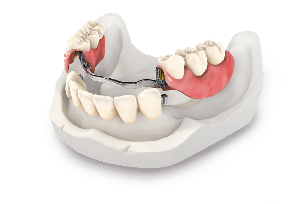 Best Cast Partial Denture with Precision Attachment in Indirapuram treatment at Kosmoss Dental Indirapuram