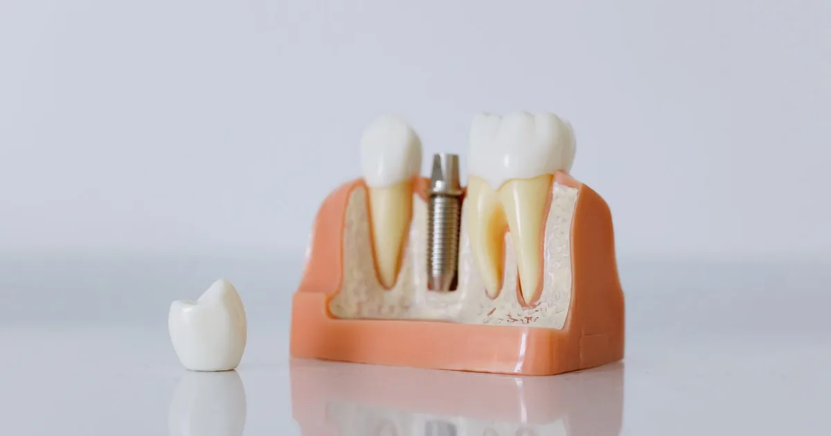 Dental Implants in Indirapuram: Cost, Pain, Recovery and What to Expect