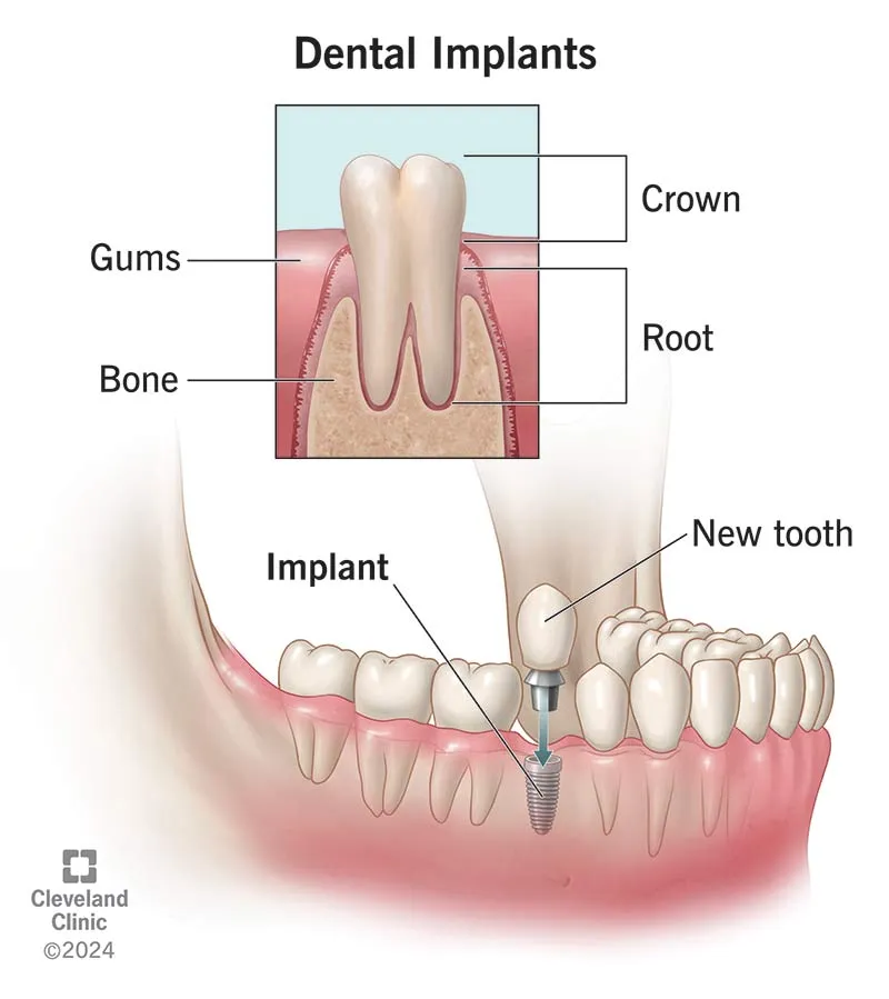 Dental Implants in Indirapuram treatment at Kosmoss Dental Indirapuram