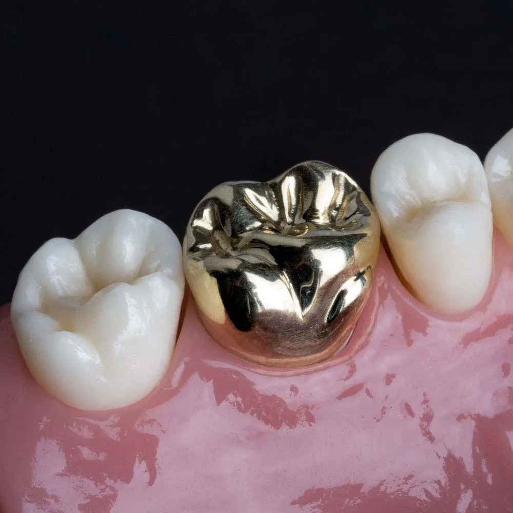 Metal Crown treatment at Kosmoss Dental Indirapuram