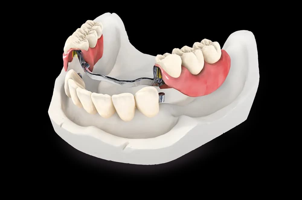Cast Partial Denture with Precision Attachment in Indirapuram treatment at Kosmoss Dental Indirapuram