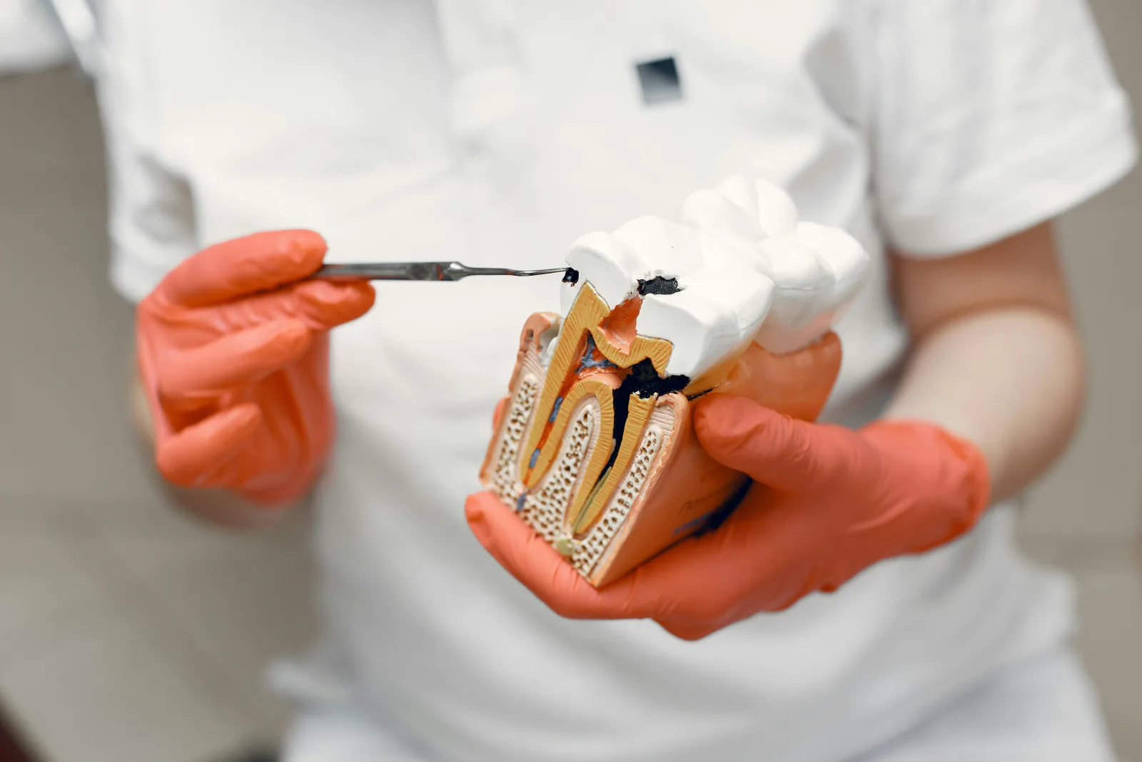 Root Canal Treatment (RCT) in Indirapuram treatment at Kosmoss Dental Indirapuram