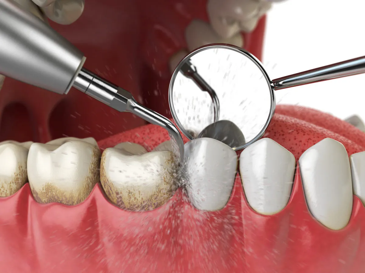 Best Scaling and Polishing Treatment in Indirapuram treatment at Kosmoss Dental Indirapuram