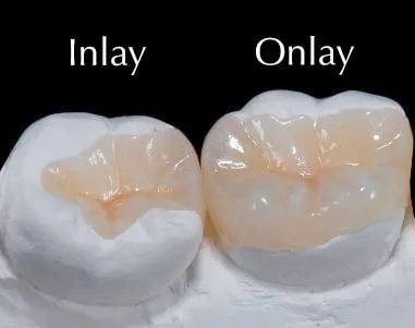 Restoration - Inlays / Onlays Prosthesis treatment at Kosmoss Dental Indirapuram